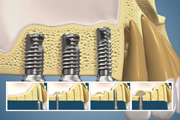 Sinus Lift with Implant Placement